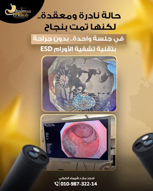 نجاح استئصال ورمين في الجهاز الهضمي